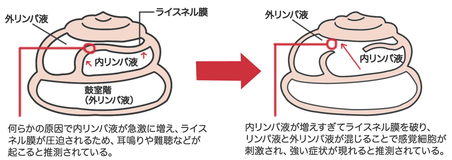 メニエール病の原因は内リンパ液の異常と考えられている