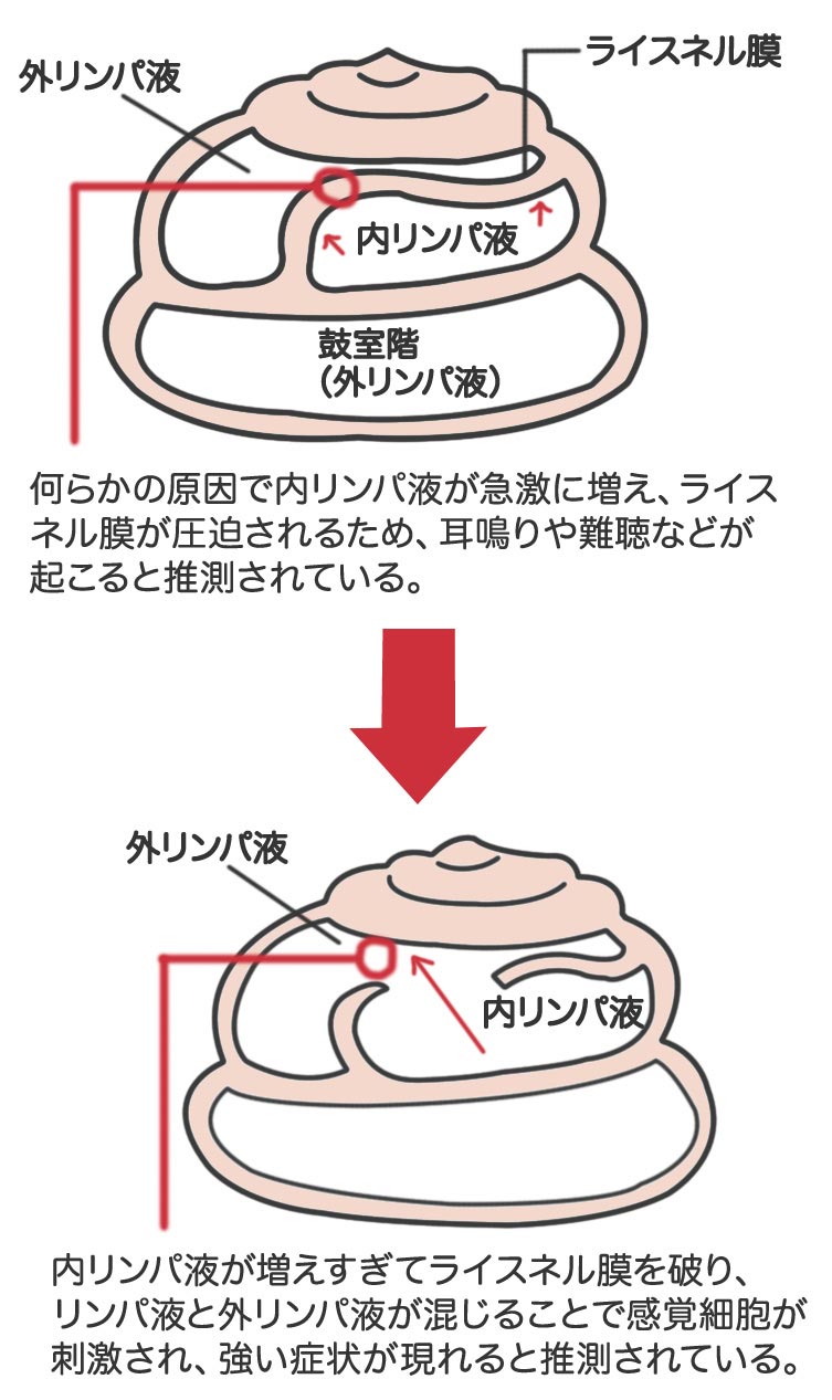 ���j�G�[���a�̌����͓������p�t�ُ̈�ƍl�����Ă���